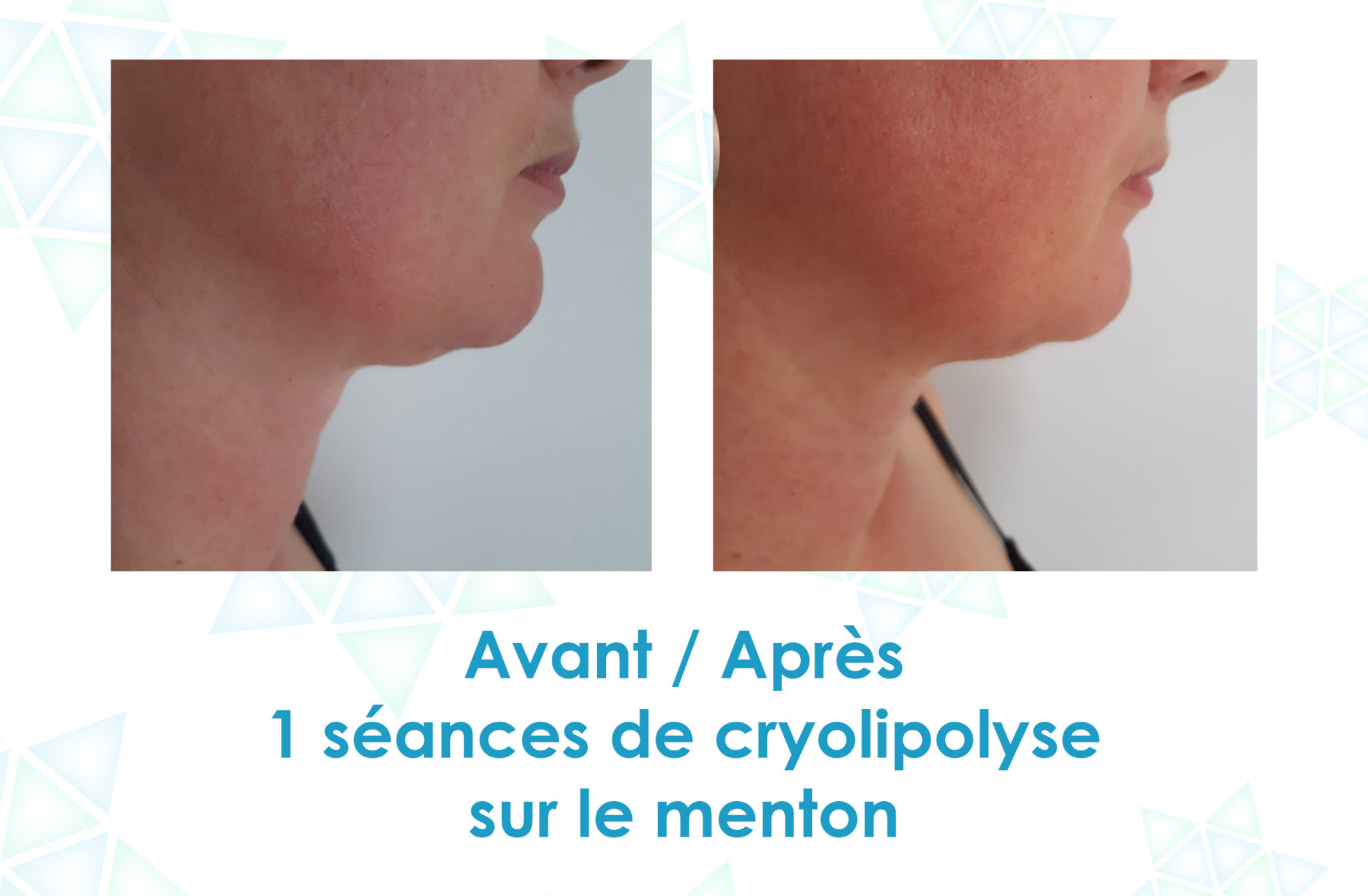 Loeline, votre institut de cryolipolyse à Saintes — free download